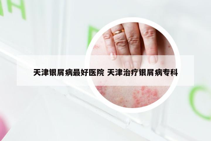天津银屑病最好医院 天津治疗银屑病专科