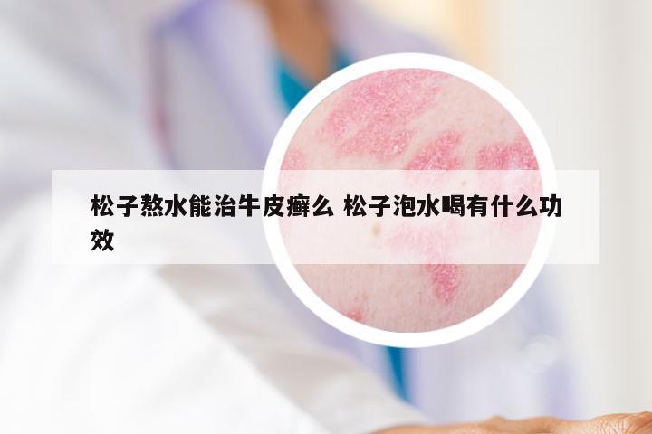 松子熬水能治牛皮癣么 松子泡水喝有什么功效