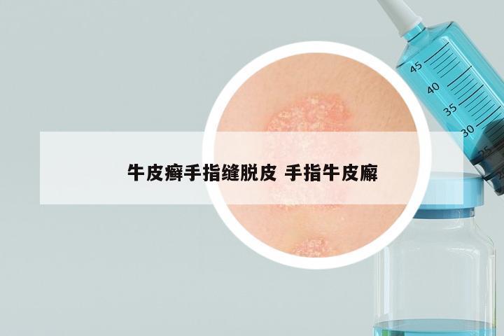 牛皮癣手指缝脱皮 手指牛皮廨