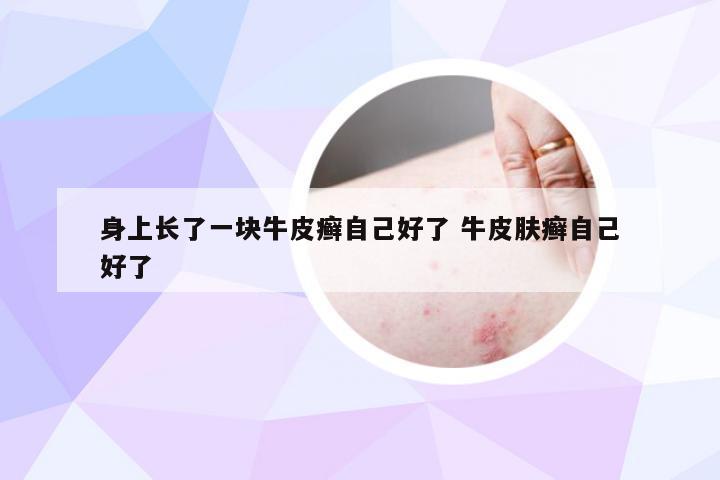 身上长了一块牛皮癣自己好了 牛皮肤癣自己好了