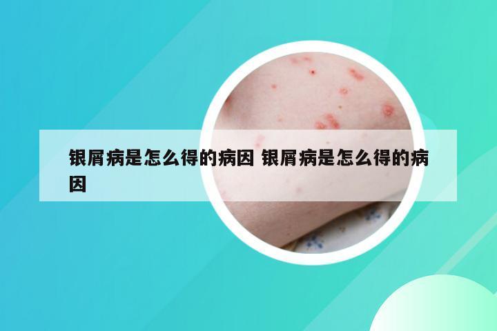 银屑病是怎么得的病因 银屑病是怎么得的病因