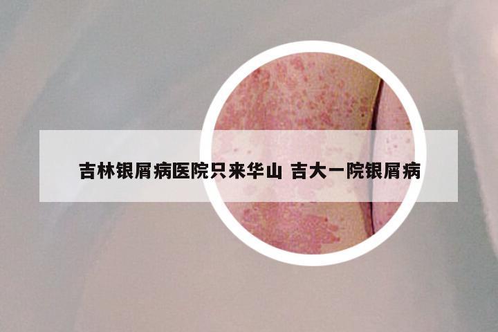 吉林银屑病医院只来华山 吉大一院银屑病
