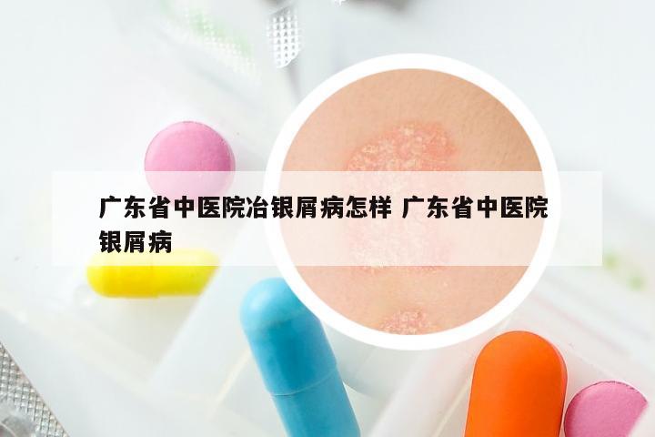 广东省中医院冶银屑病怎样 广东省中医院 银屑病