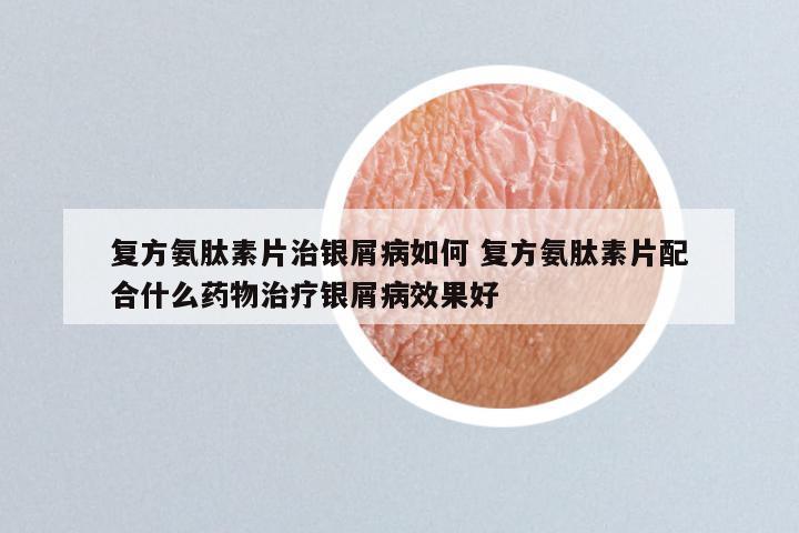 复方氨肽素片治银屑病如何 复方氨肽素片配合什么药物治疗银屑病效果好