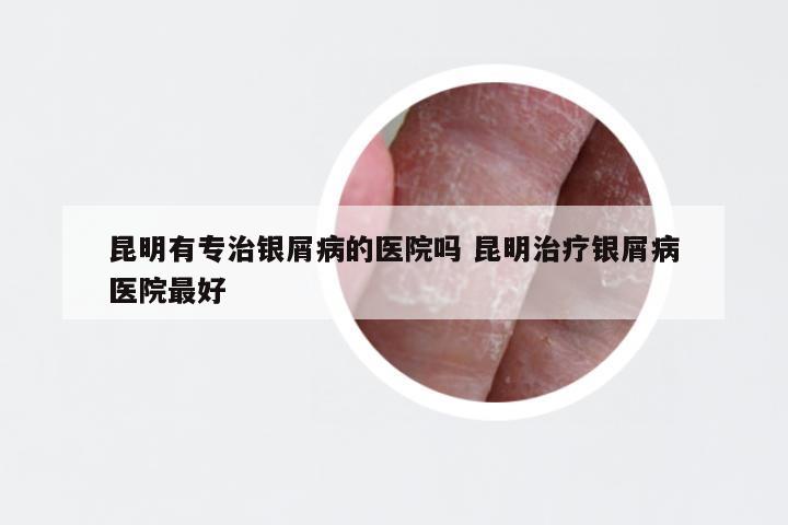 昆明有专治银屑病的医院吗 昆明治疗银屑病医院最好