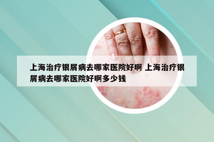 上海治疗银屑病去哪家医院好啊 上海治疗银屑病去哪家医院好啊多少钱