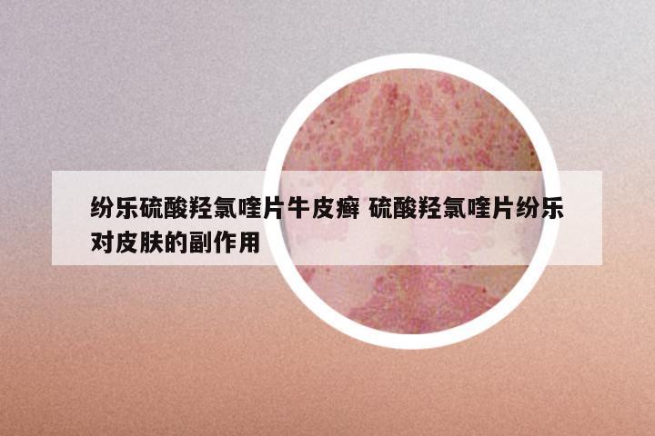 纷乐硫酸羟氯喹片牛皮癣 硫酸羟氯喹片纷乐对皮肤的副作用