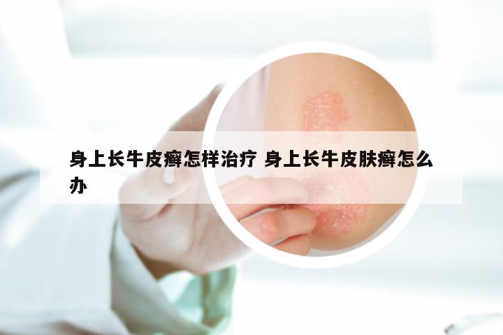 身上长牛皮癣怎样治疗 身上长牛皮肤癣怎么办