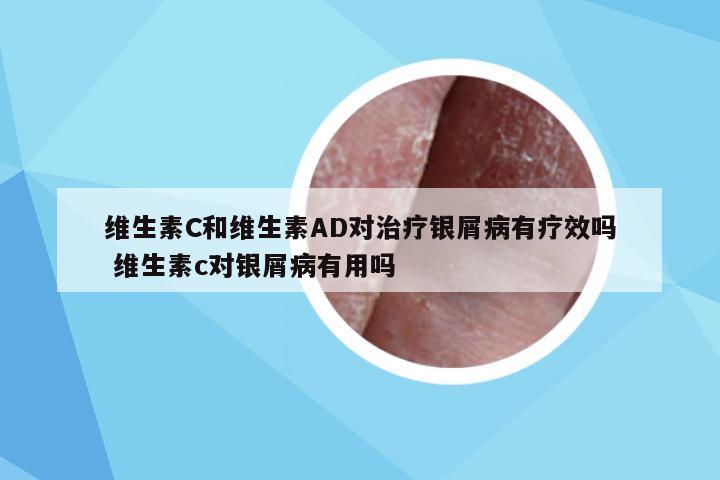 维生素C和维生素AD对治疗银屑病有疗效吗 维生素c对银屑病有用吗