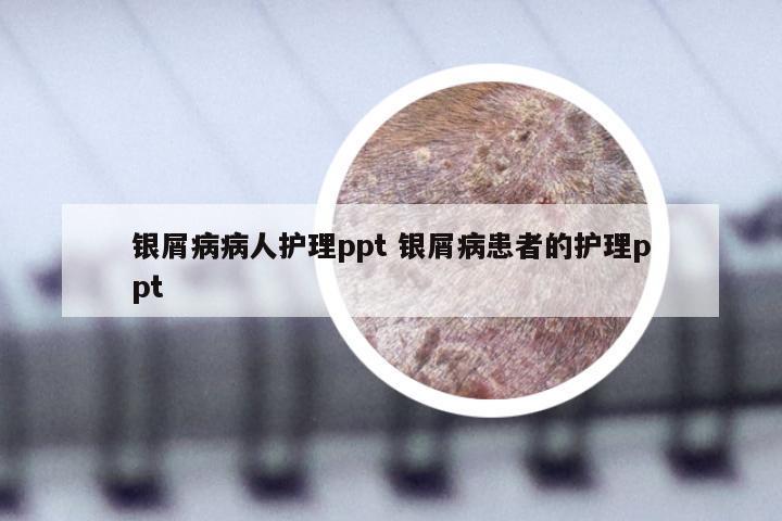 银屑病病人护理ppt 银屑病患者的护理ppt