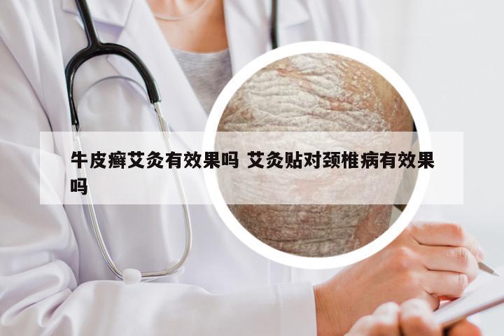 牛皮癣艾灸有效果吗 艾灸贴对颈椎病有效果吗