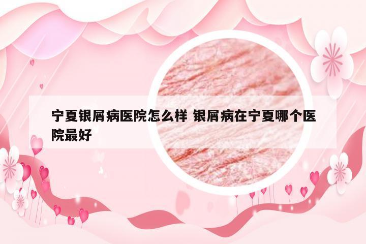 宁夏银屑病医院怎么样 银屑病在宁夏哪个医院最好