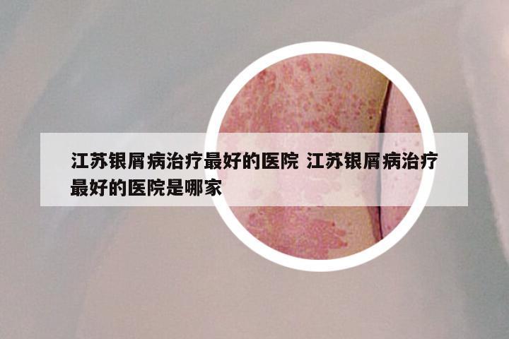 江苏银屑病治疗最好的医院 江苏银屑病治疗最好的医院是哪家