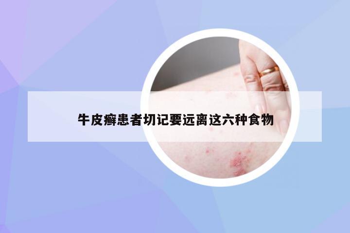 牛皮癣患者切记要远离这六种食物