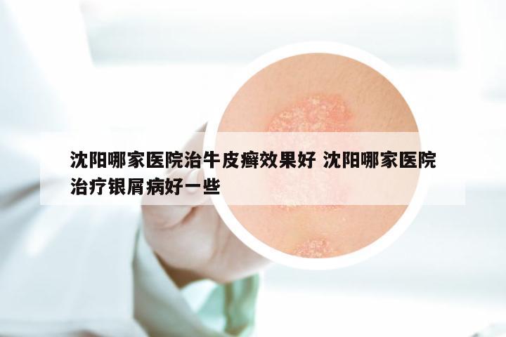 沈阳哪家医院治牛皮癣效果好 沈阳哪家医院治疗银屑病好一些