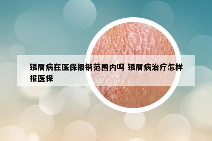 银屑病在医保报销范围内吗 银屑病治疗怎样报医保