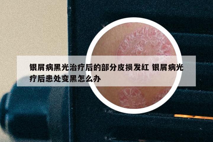 银屑病黑光治疗后的部分皮损发红 银屑病光疗后患处变黑怎么办