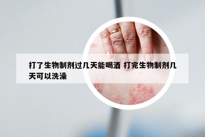 打了生物制剂过几天能喝酒 打完生物制剂几天可以洗澡