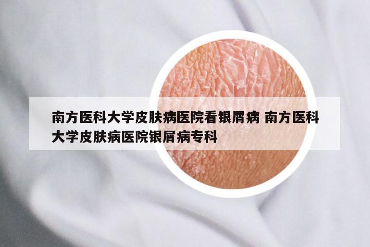南方医科大学皮肤病医院看银屑病 南方医科大学皮肤病医院银屑病专科