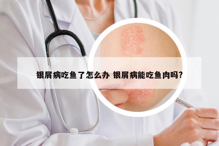 银屑病吃鱼了怎么办 银屑病能吃鱼肉吗?