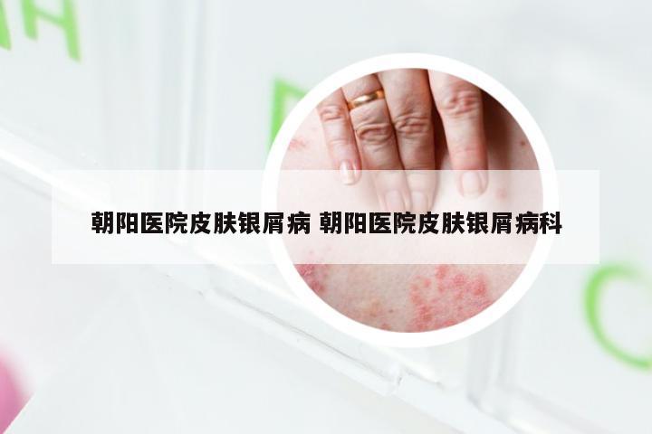 朝阳医院皮肤银屑病 朝阳医院皮肤银屑病科