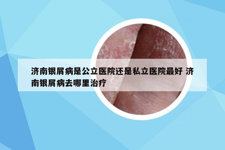 济南银屑病是公立医院还是私立医院最好 济南银屑病去哪里治疗