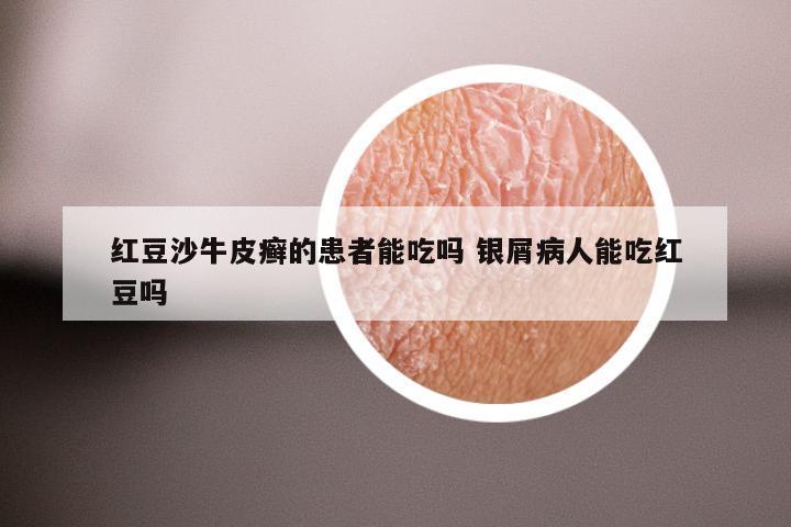 红豆沙牛皮癣的患者能吃吗 银屑病人能吃红豆吗
