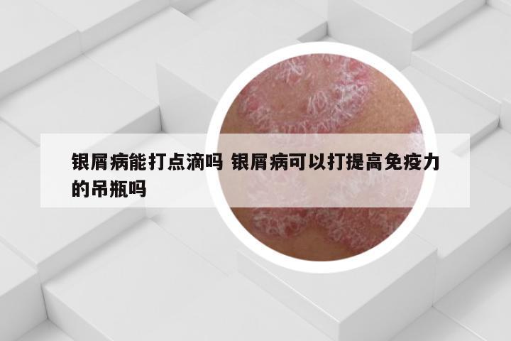 银屑病能打点滴吗 银屑病可以打提高免疫力的吊瓶吗
