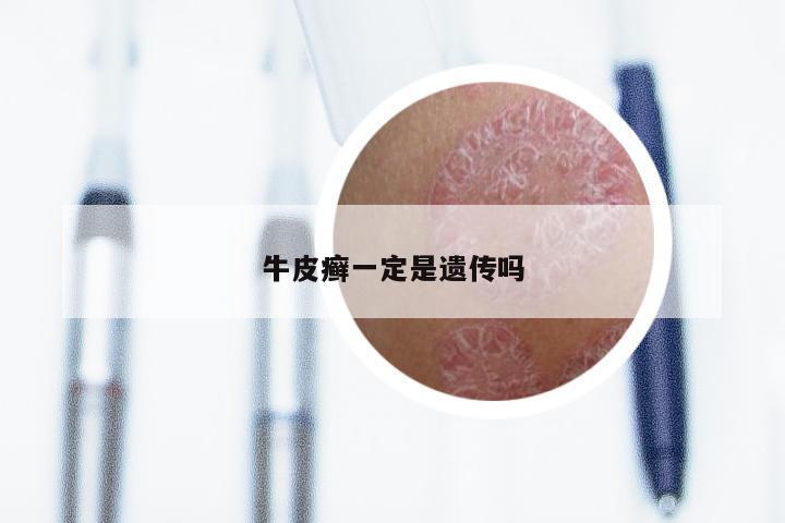 牛皮癣一定是遗传吗