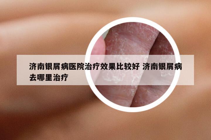 济南银屑病医院治疗效果比较好 济南银屑病去哪里治疗