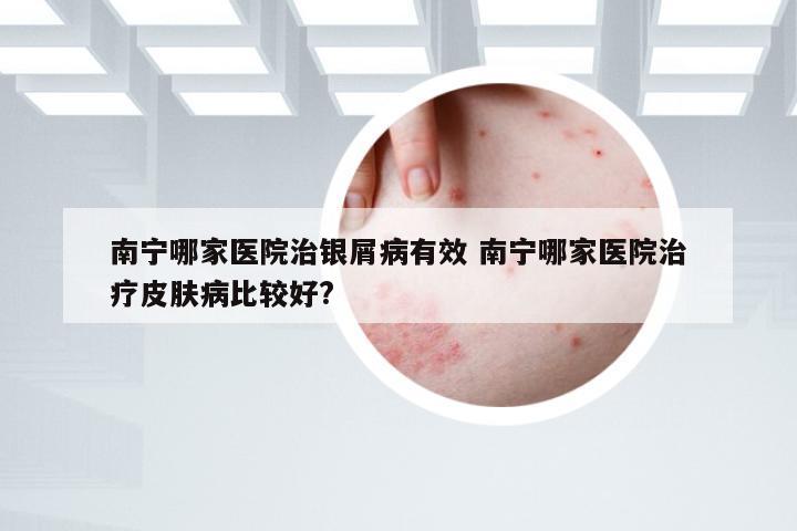 南宁哪家医院治银屑病有效 南宁哪家医院治疗皮肤病比较好?
