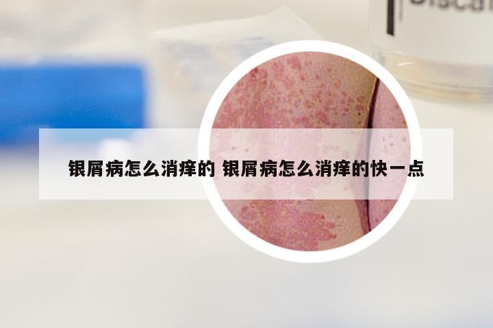 银屑病怎么消痒的 银屑病怎么消痒的快一点