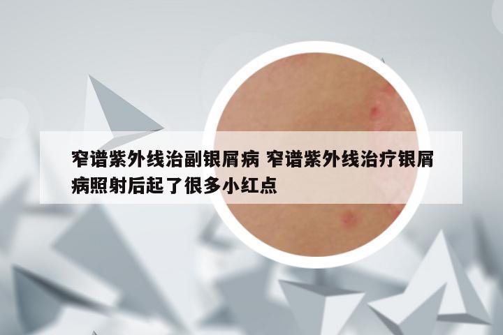 窄谱紫外线治副银屑病 窄谱紫外线治疗银屑病照射后起了很多小红点