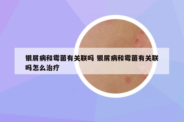 银屑病和霉菌有关联吗 银屑病和霉菌有关联吗怎么治疗