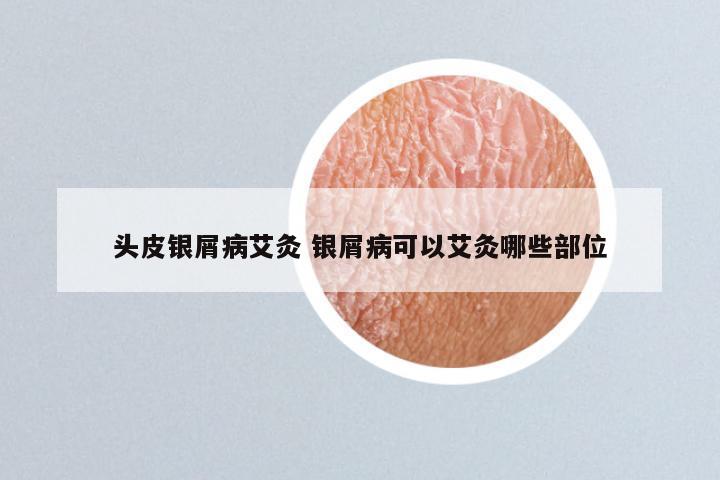 头皮银屑病艾灸 银屑病可以艾灸哪些部位