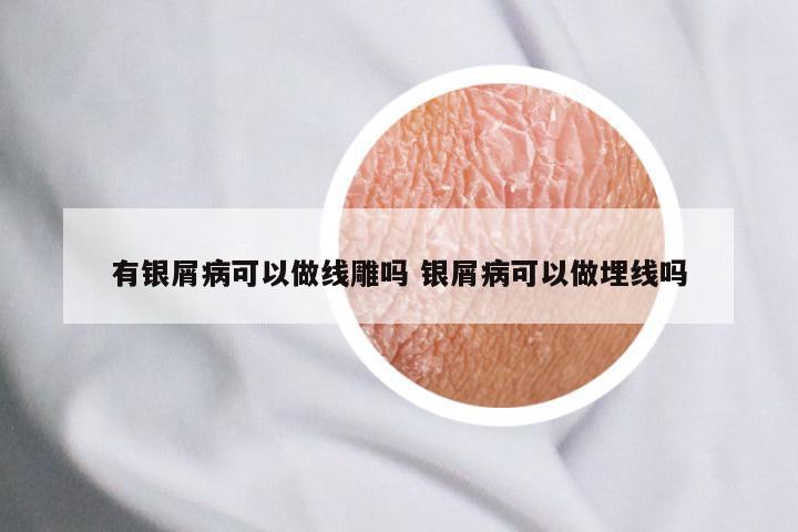 有银屑病可以做线雕吗 银屑病可以做埋线吗