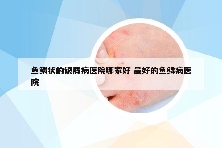 鱼鳞状的银屑病医院哪家好 最好的鱼鳞病医院