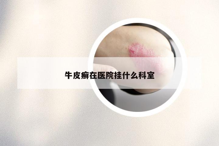 牛皮癣在医院挂什么科室