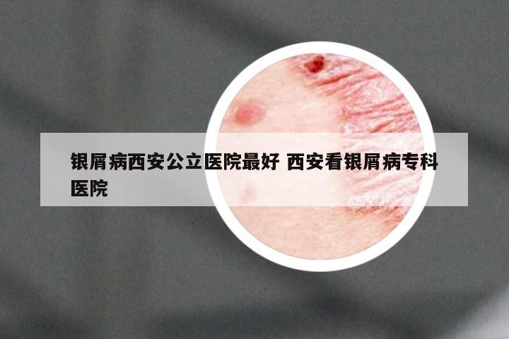 银屑病西安公立医院最好 西安看银屑病专科医院