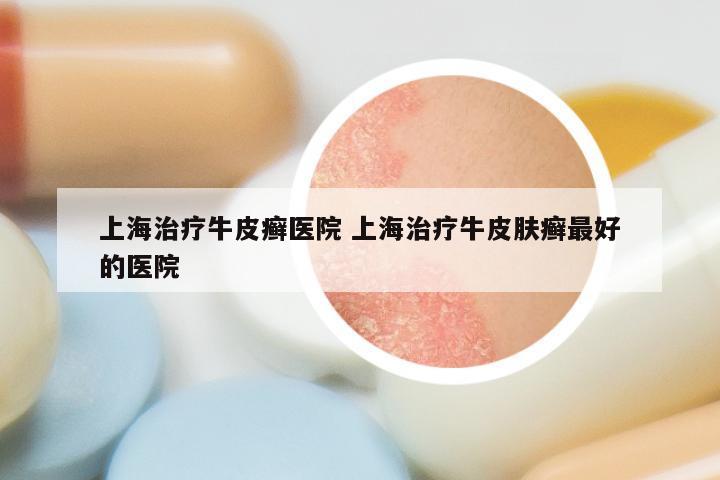 上海治疗牛皮癣医院 上海治疗牛皮肤癣最好的医院