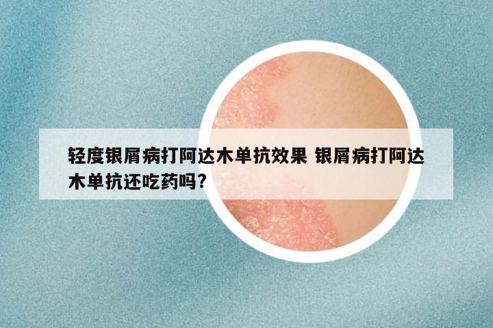 轻度银屑病打阿达木单抗效果 银屑病打阿达木单抗还吃药吗?