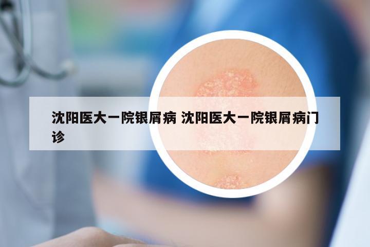 沈阳医大一院银屑病 沈阳医大一院银屑病门诊