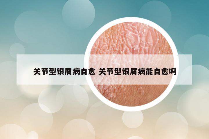 关节型银屑病自愈 关节型银屑病能自愈吗