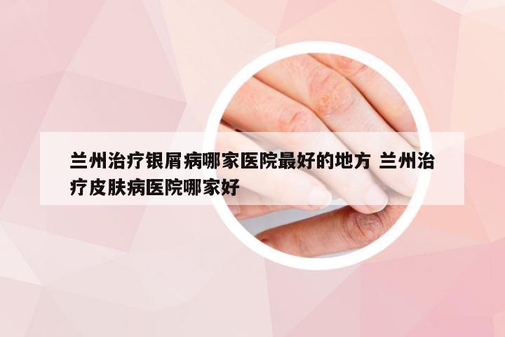 兰州治疗银屑病哪家医院最好的地方 兰州治疗皮肤病医院哪家好