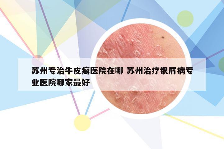 苏州专治牛皮癣医院在哪 苏州治疗银屑病专业医院哪家最好