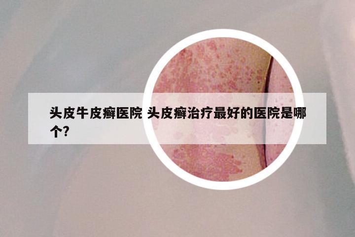 头皮牛皮癣医院 头皮癣治疗最好的医院是哪个?