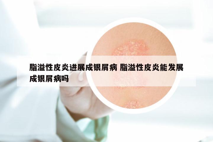 脂溢性皮炎进展成银屑病 脂溢性皮炎能发展成银屑病吗