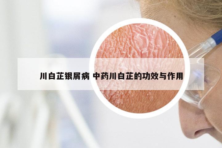 川白芷银屑病 中药川白芷的功效与作用