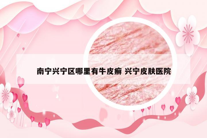 南宁兴宁区哪里有牛皮癣 兴宁皮肤医院