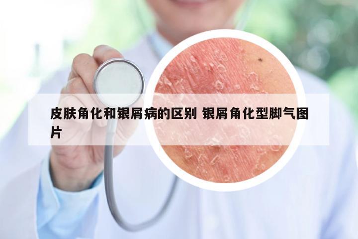皮肤角化和银屑病的区别 银屑角化型脚气图片